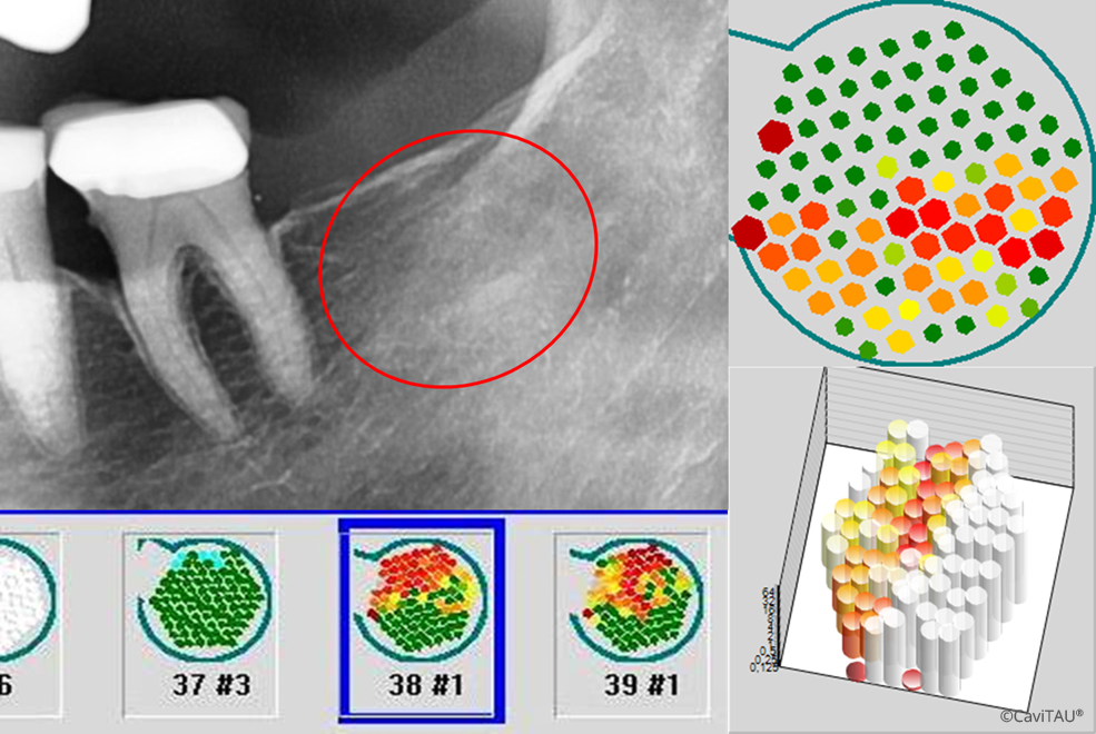 CaviTAU Messergebnis