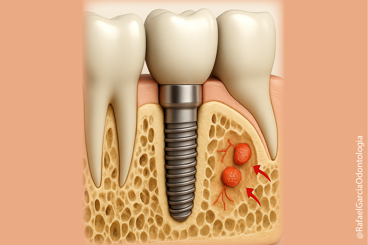 Zahn Implantat Illustration